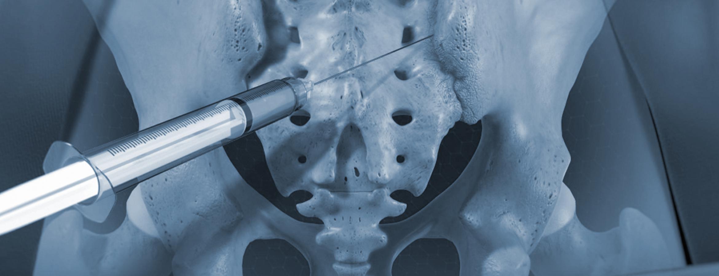 Sacroiliac (SI) Joint Injection